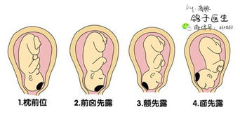 分娩时,警惕几种常见的异常胎位