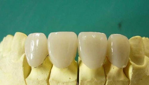 戴上烤瓷牙牙疼是怎么回事 医生 出现这3种问题,小心牙齿烂掉