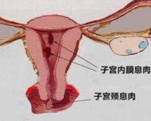 子宫内膜息肉的病因是什么，试管助孕前该怎么办？