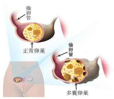 卵巢多囊能怀孕吗(多囊卵巢女性可以自然怀孕吗为什么)