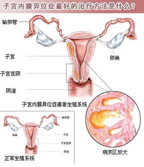 子宫内膜异位症　您了解吗