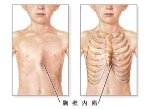 鸡胸如何矫正