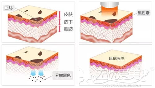 都是激光美肤 ,祛痣 祛斑 除皱用的激光仪器却不同