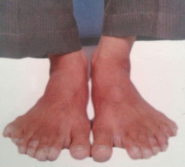 印度木匠患多指症 每个手脚都有7根指头 