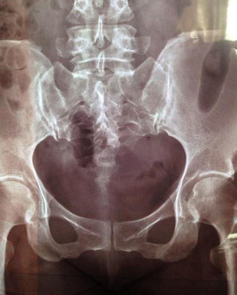 尾椎骨在哪个位置图片,徐姑姑的尾骨骨折，需要康复多久？为什么没去医院就好了？