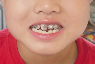 孩子在换牙时期,我们应该注意哪些呢 该怎样解决呢