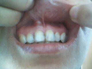 牙龈上长了个白色的不太疼的硬疙瘩 是什么东西 