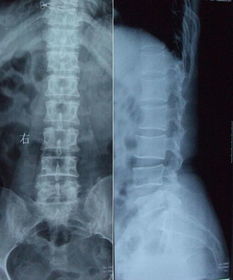 腰椎间盘突出症 手术还是不手术
