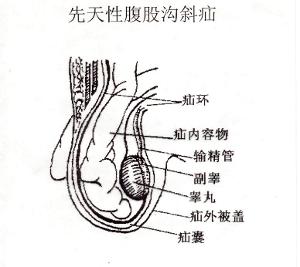 女性腹股沟疝气患者要注意哪些呢?有什么