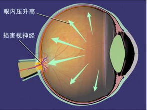 少年儿童也会得青光眼 哪些情况小心青光眼 窃取 视力