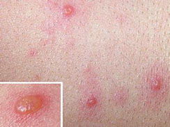 水痘疤痕能消退吗,水痘疤痕可以消除吗？