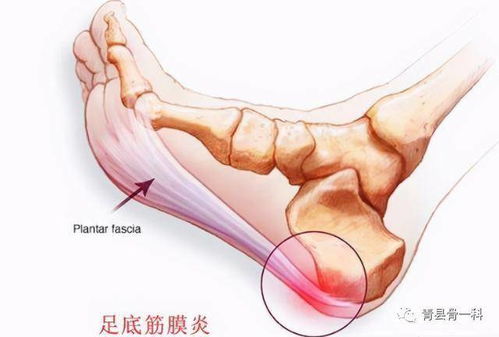 脚底疼痛是怎么回事