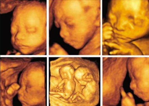 同样是怀孕,为啥单胎需要做唐氏筛查和四维彩超 而双胎没必要做