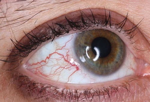 眼睛有红血丝是什么原因,眼睛有红血丝是什么原因引起的起的