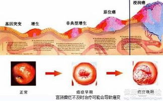 宫颈糜烂要不要治