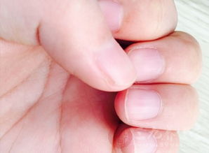 指甲有坚纹 指甲表面有明显的竖纹是怎么回事