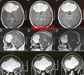 罕见超巨大脑膜瘤被成功全切除 原创