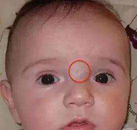 宝宝鼻梁上有青筋是疾病的征兆 孕期应该如何避免宝宝出生青筋