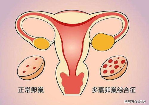 得了多囊卵巢综合症怎么办