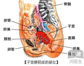 子宫腺肌症到什么情况的时候需要做手术 子宫腺肌症必须要手术吗