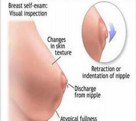 乳腺增生术后会复发吗 