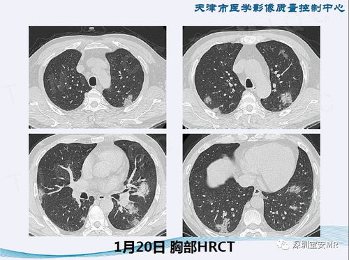 新型冠状病毒感染肺炎影像学表现 阶段性总结