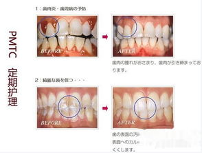 松牙固定治疗步骤 