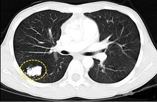 肺结节与肺癌的关系 中医如何治疗