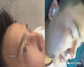 内蒙古一男子隆鼻后疼到不能碰,50岁大夫自开门脸房就敢手术