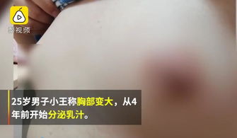 25岁男子胸部长成b罩杯,不敢穿紧身衣服,一碰就喷乳汁 