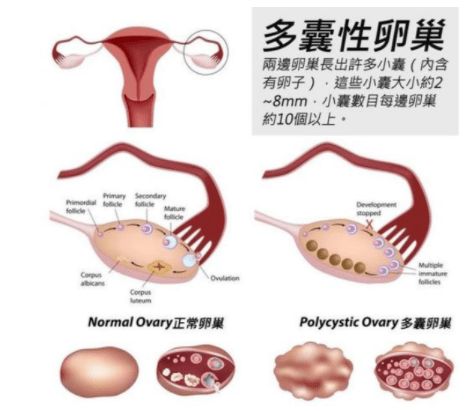 与热依扎袭击式晒娃相比,有人却在吃备孕的苦,患了多囊卵巢还有救吗