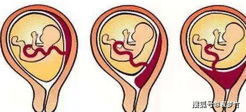 怀孕胎儿位置在前壁和后壁有什么不同吗