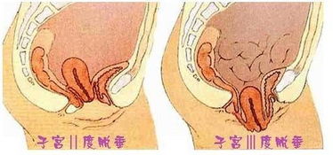 保健艾灸师 阴挺怎么艾灸 阴挺的艾灸治疗方法 