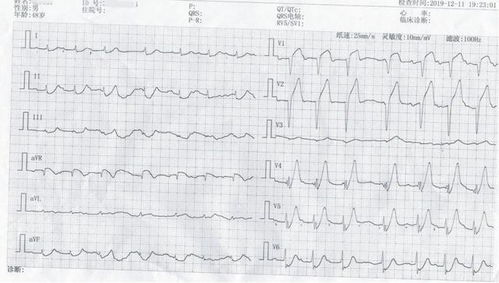 如何判断心电图ST段下移的性质