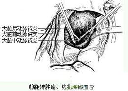 先天性脑血管畸形要手术吗