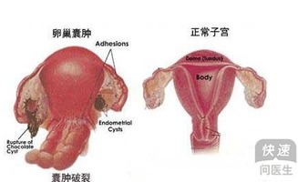 卵巢囊肿腹腔镜手术后多久可以同房 治疗费用要清楚