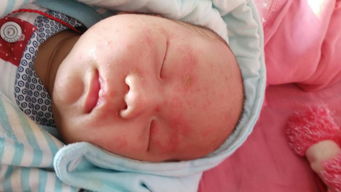 婴儿身体湿疹护理,宝宝湿疹怎么护理