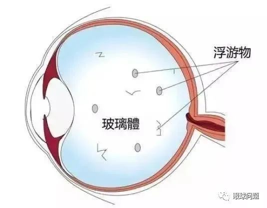 为什么中医治疗飞蚊症会被患者认可