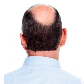 头顶头发掉是什么原因解答男性头顶头发稀少怎么办 