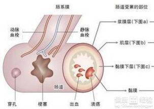 不完全肠梗阻吃什么药