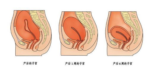 子宫复旧不全的症状有哪些 如何刺激子宫恢复
