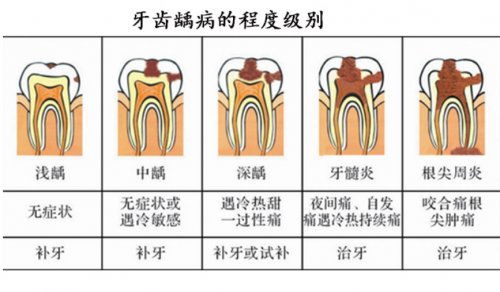 儿童虫牙蛀牙龋 qu 齿有什么坏处 怎么解决