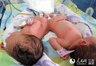 江西宁都一孕妇产下连体女婴 连夜奔赴上海准备施分离手术