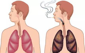 十年烟龄戒烟后肺部恢复洁净需要多长时间
