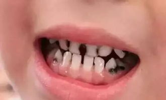 儿童蛀牙要不要治 