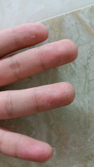 我的手指长了很多小泡,有的破皮破的惨不忍睹是什么原因,怎么治疗,谢谢,这个问题是一个月内出现的,本 