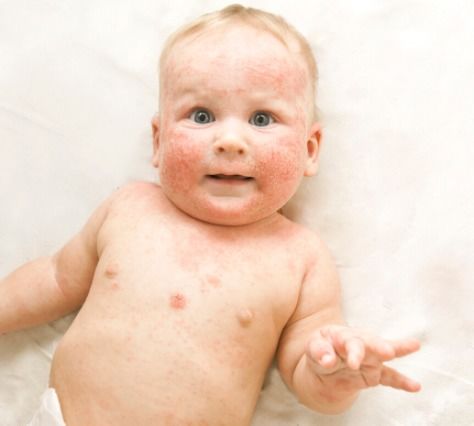 新生儿湿疹图片？宝宝湿疹和热疹的区别图片 七种区别教你区分宝宝湿疹和热疹