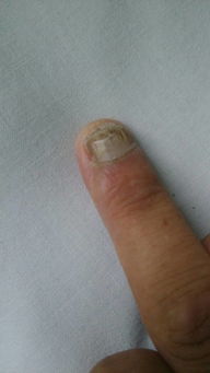 手指甲变成白色了而且厚了是啥原因 就这一个手指 