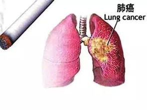 肺癌 中医辨证治疗的重要性
