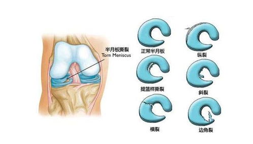 半月板损伤是什么原因引起的